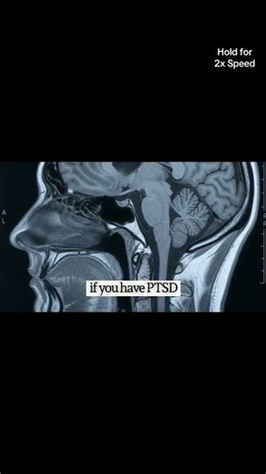 PTSD doesn’t just affect what you remember—it can affect how your brain remembers. Trauma can affect