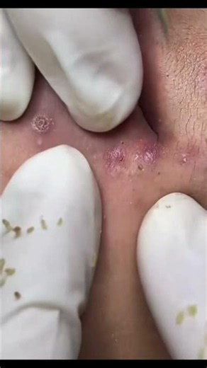 Biggest amount of blackheads i’ve ever seen in one ear😱🤤😱