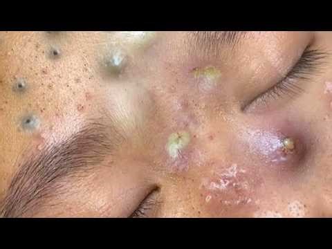 Blackheads Removal || Acne Removal - 0135 #skincare #glowup