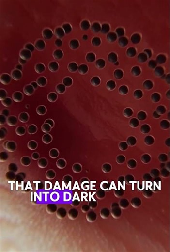 Pimple Popping 2025 | Acne Treatment and Very Satisfying Satisfying Pimple pop #blackheads Finance