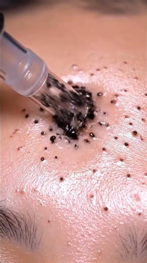 Extreme Blackhead Lab Tool Test | Deep Pore Extraction