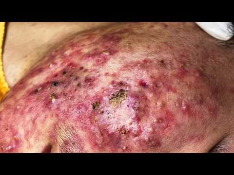 Worst Acne Ever?! Deep Cystic Acne Removal & Recovery