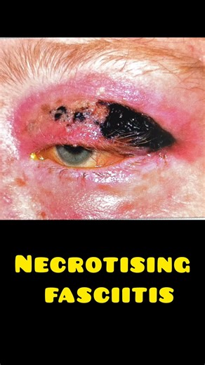 Necrotizing Fasciitis: A Medical Emergency