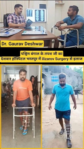 पश्चिम बंगाल के तपश जी के Tibia bone fracture का देशवार हॉस्पिटल में ilizarov Surgery से इलाज 27 Jun