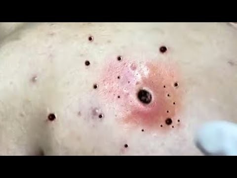 Best Satisfying Pimples Popping Cyst Removal Acne Blackheads Explosive Compilation Videos #287