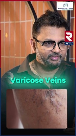 Avis Vascular Centre | Non Surgical Treatment | Best Varicose Veins Treatmen𝐭 | Avis Hospitals | RTV