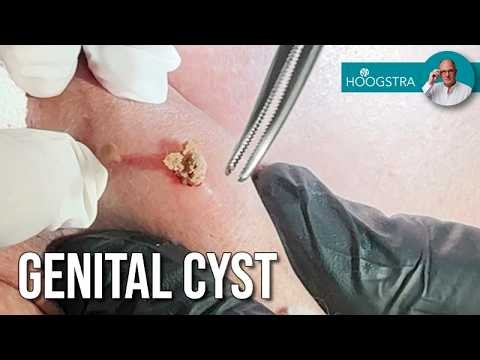Penile cyst completely removed with laser