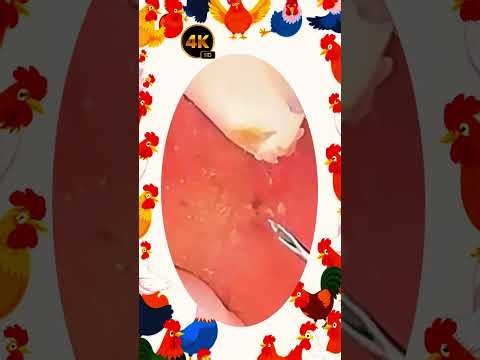 Satisfying Blackhead Removal | Acne Treatment, Pimple Pop & Deep Skin Clean-Up