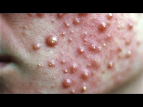 Extreme Blackhead Removal | Deep Pore Cleansing & Satisfying Acne Extraction
