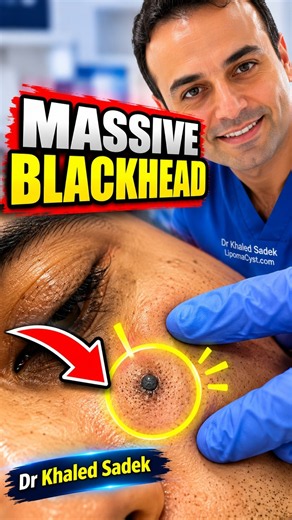 Dr Khaled Sadek. LipomaCyst.com