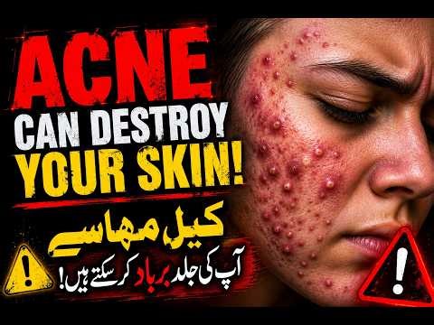 Acne Explained: Whiteheads, Blackheads & Cystic Acne | Causes, Treatment & Skincare Tips