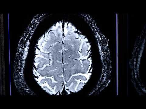Dr. Todd Schwedt – Migraine is incredibly disabling