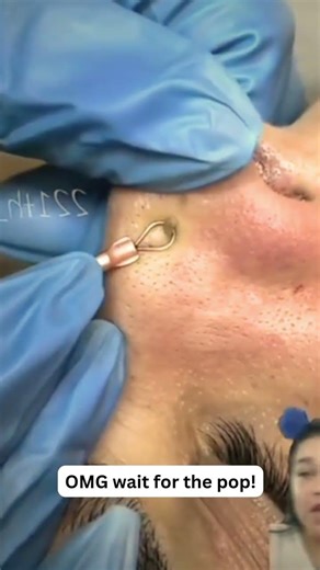 Large Blackheads Extraction Big Cystic Acne Blackheads&Whiteheads Removal Pimple Popping #1011 2026