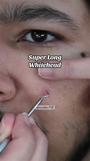 This whitehead was deep in there #acne #pimple #foryoupage #extractions #satisfying