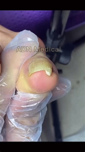 Satisfying Toenail Grooming | Gentle Foot Care Routine #fypシ #cleannails #RelaxingCare #fypシ | ADN Medical