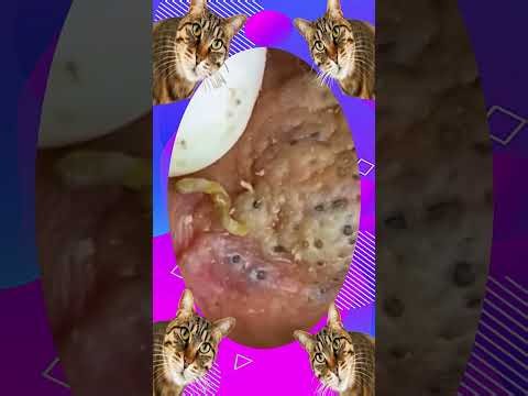 Satisfying self-cleaning of blackheads Acne Treatment Pimple pop