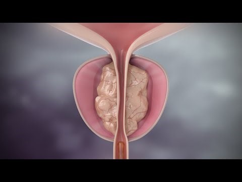 Rezum provides a gentler alternative to surgery for benign prostate enlargement