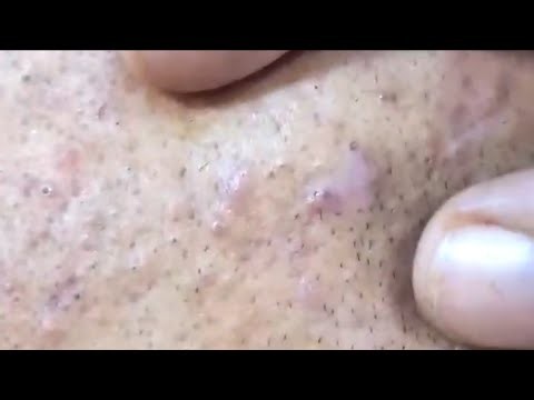 blackheads acne blackheads removal | pimple popping Today new | by Sac Dep Spa 2026