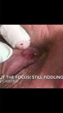 Dr. Pimple Popper Removes Blackhead Near the Eye