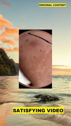 Juicy juicy!! Visit our profile for more pimple pops!!