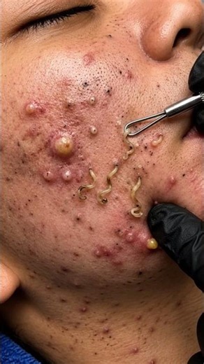 Extreme Blackhead & Acne Extraction ASMR | Giant Sebum Plugs Removed
