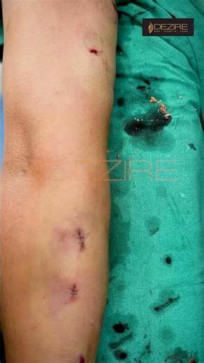 Lipoma Removal | Lipoma Treatment