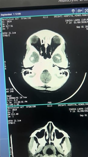 Ct Scan Child Brain Process