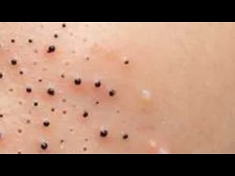 Acne Treatment & Blackhead Removal | Very Satisfying Pimple Popping #308
