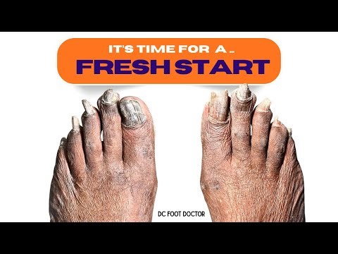 Let's Get Going: Trimming Fungal Toenails, Starting Treatment