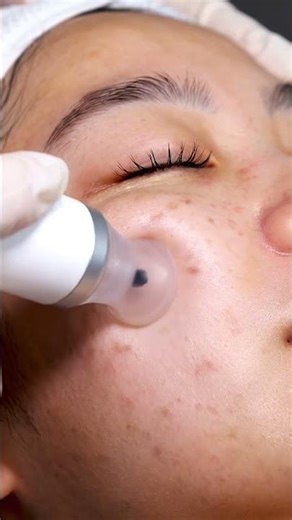 "Satisfying Pimple Popping | Deep Acne Removal Compilation"