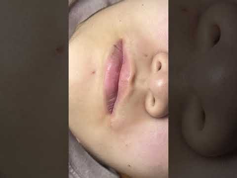 Deep Blackhead Extraction on a 9th Grade Student 😱 | Satisfying Acne Removal