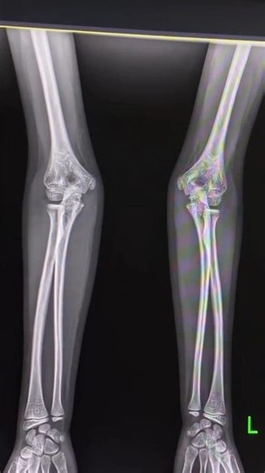 elbow & radius & ulna x ray image find fracture and disease 🤔👆👆👆👆