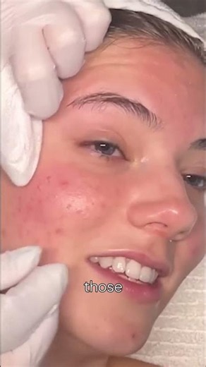 Satisfying Pimple Pop: HUGE Blackhead EXPOSED! #shorts