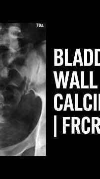 Symptoms Of Urinary Frequency & Urgency In A 46-Year-Old Female | Rapid Review Case 70