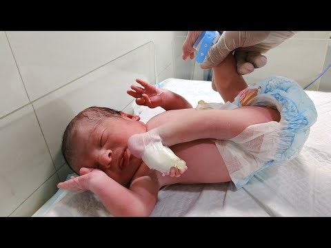 Arthrogryposis Multiplex Congenita (AMC) newborn baby mein ek rare congenital condition....