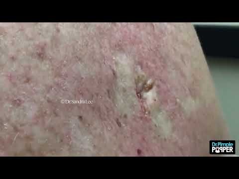 Watch This Huge Dilated Pore Get Completely Extracted... A Dr Pimple Popper Classic!