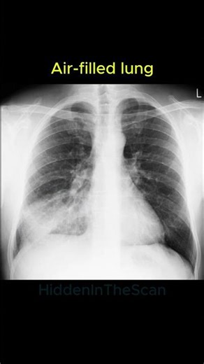 Can you spot pneumonia on X-ray? 🫁