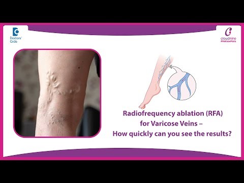 Varicose Veins Procedure Aftercare | Do’s & Don’ts - Dr. Junaid Ahmed Jamadar | Doctors' Circle