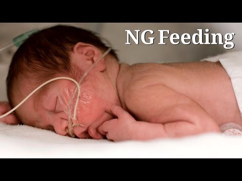 NG Tube Feeding for Newborns Everything Parents Need to Know 🤍👀