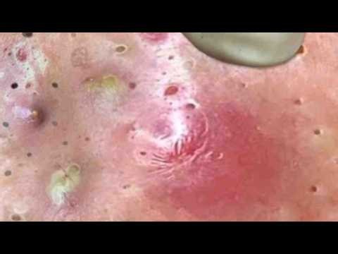 Deep blackhead Removal 2026, acne removal spa, big pimple 2026, #acne #pimple #cyst