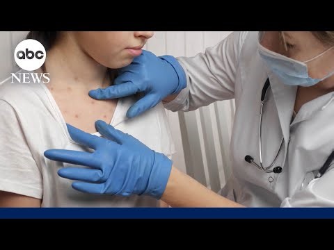 Measles outbreak growing in South Carolina