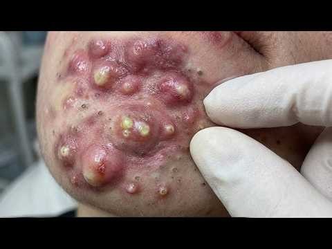 Big Cystic Blackhcads Extraction Blackheads & Milia, Whitchcads Removal #2058