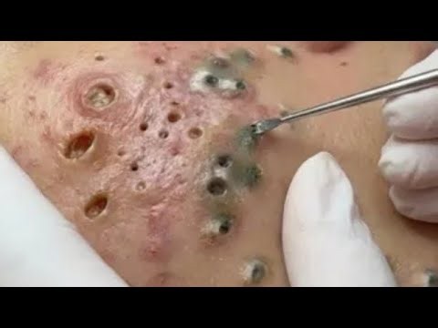 Deep blackhead Removal 2026, acne removal spa, big pimple 2026, #acne #pimple #cyst