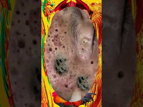 Blackheads Removal #142 | Acne Treatment and Very Satisfying Satisfying Pimple pop #blackheads