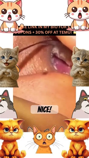 JUICY Double Cyst 😷💦 Huge pop!!