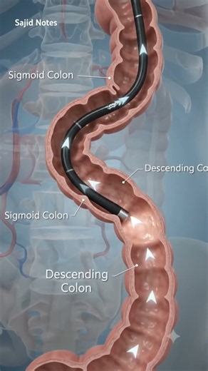 Colonoscopy Procedure Explained#Colonoscopy #Colon #MedicalAnimation