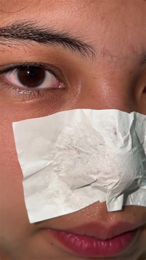 Effective Blackhead and Whitehead Removal with Landena