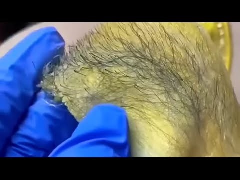 Brazilian waxing tutorial‼️satisfying results😱 | smooth wax(26)#waxing#viral#brazilian#wax#sugaring