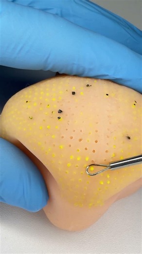 ASMR Deep Pore Cleansing 💥 Extreme Blackhead Removal Challenge 🔬💛
