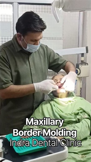 Border Molding in Complete Denture #completedenture #dental #shorts